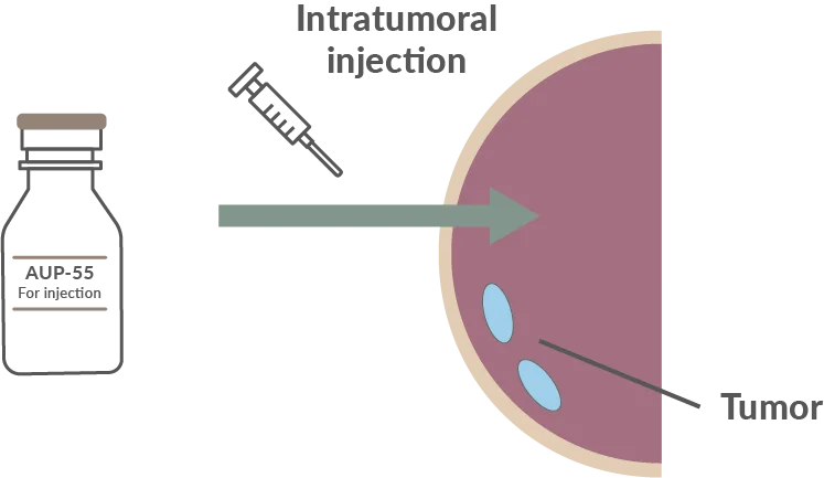 Illustration of AUP-55 being used as intratumoral injection